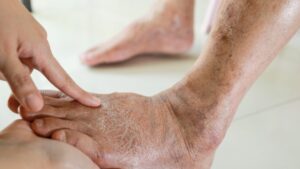 alertan-que-remedios-populares-empeoran-las-lesiones-por-pie-diabetico